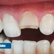 Traumatismos dentales Santander