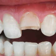 traumatismo dental santander